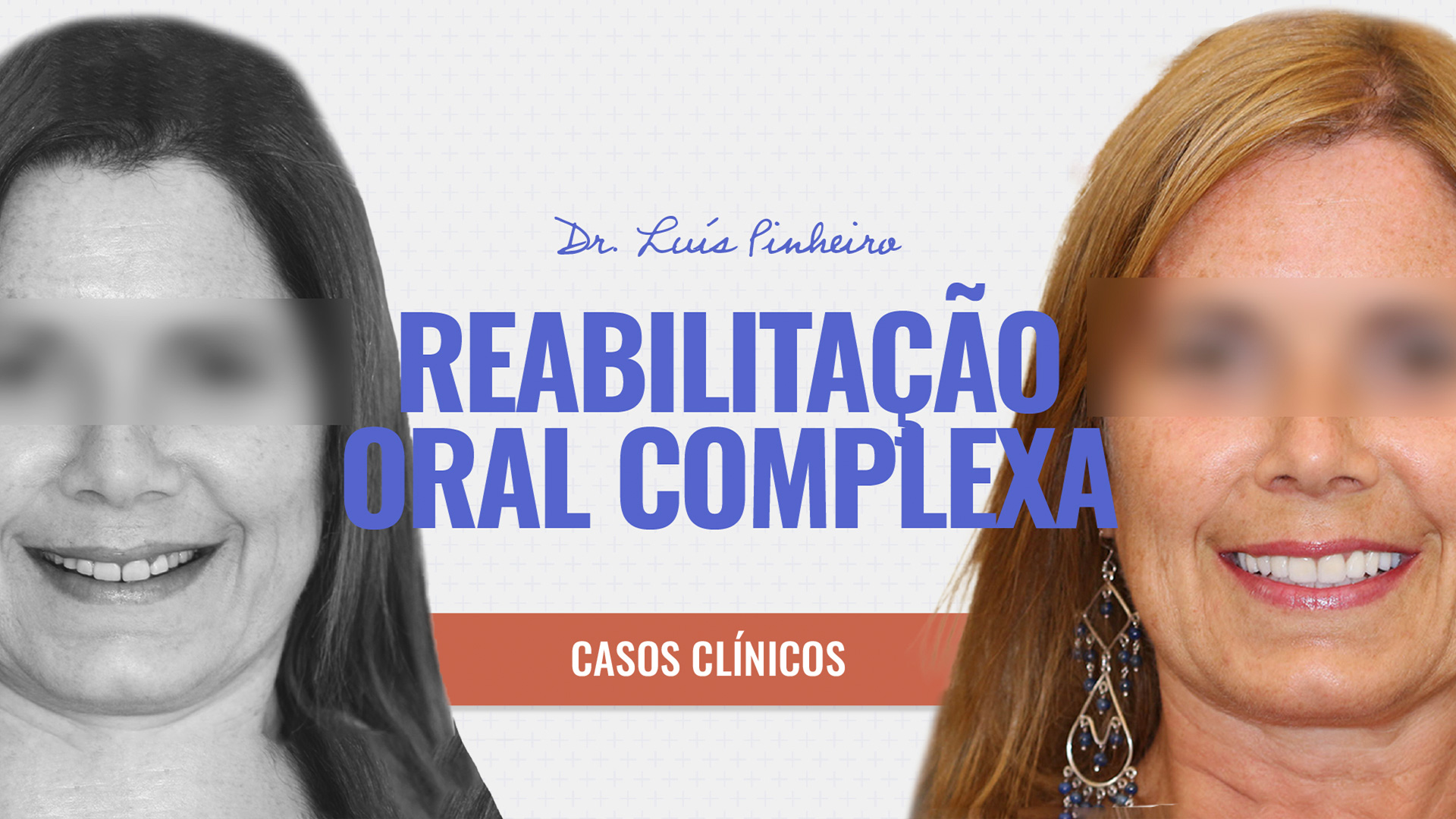Caso Clínico – Reabilitação Oral Complexa | 2