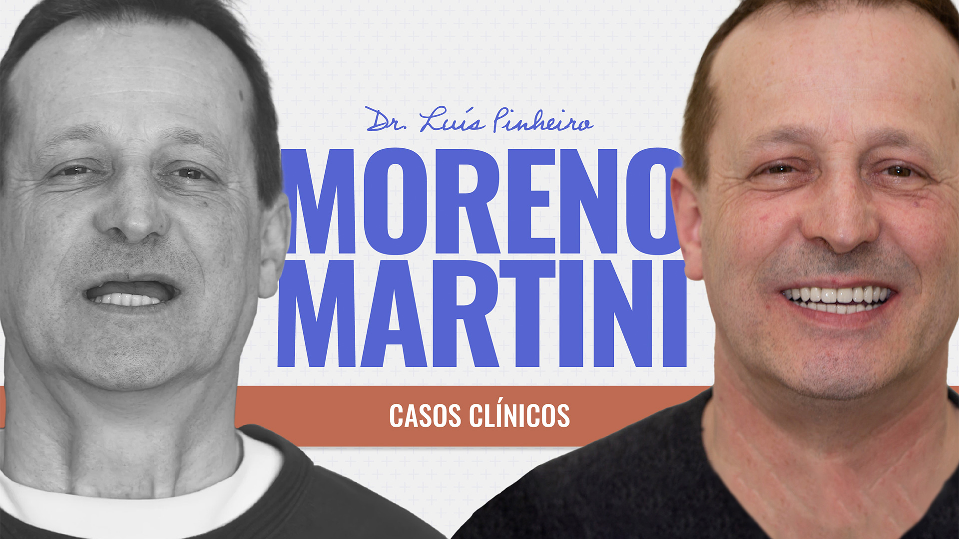 moreno martini dentes em 1 dia