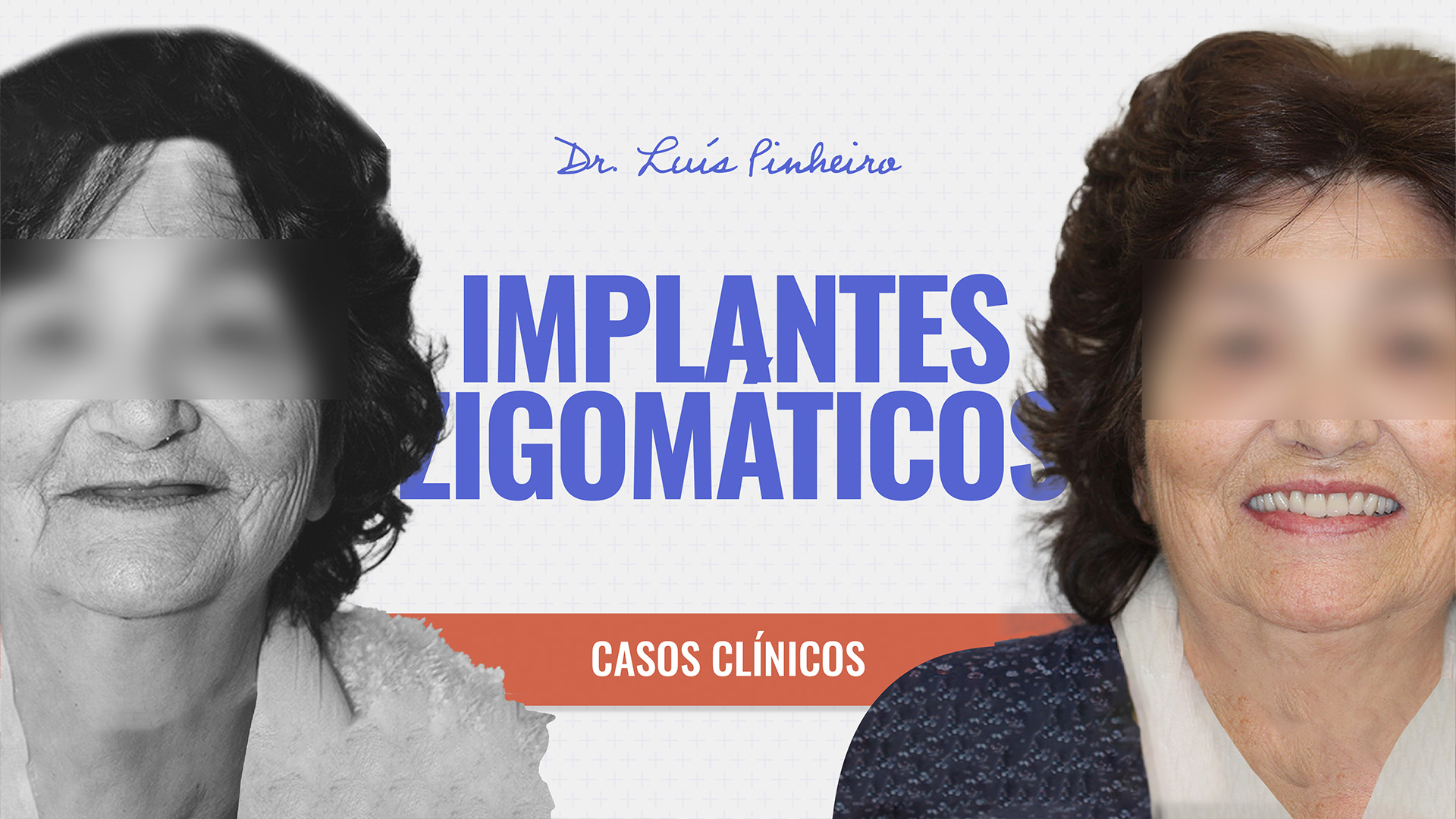 Caso Clínico – Implantes Zigomáticos | 1