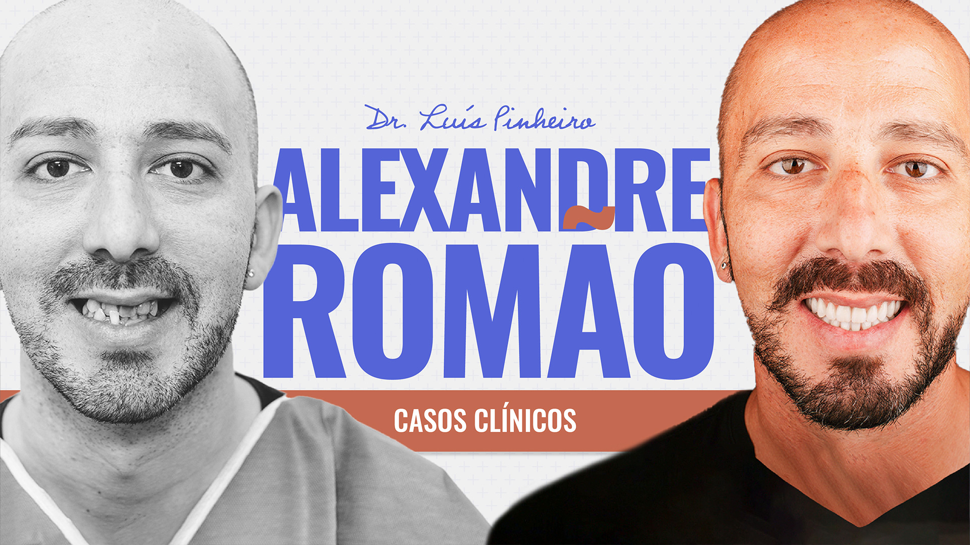 alexandre romão dentes em 1 dia