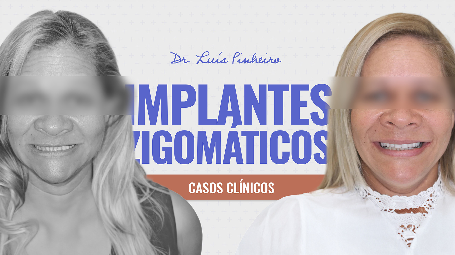 Caso Clínico - Implantes Zigomáticos | 2