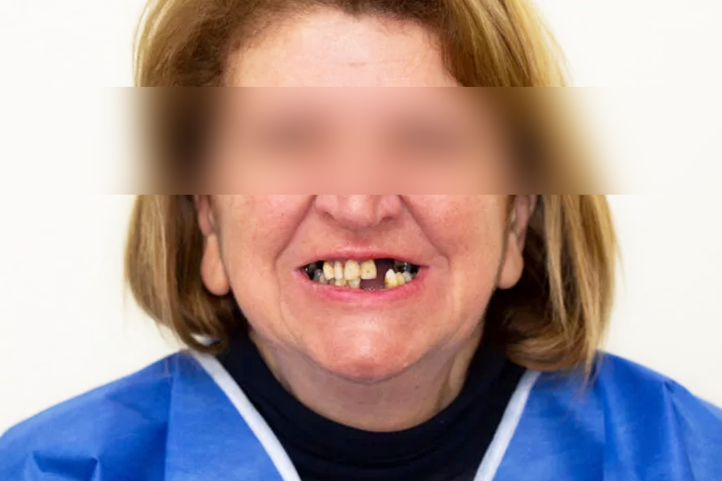 Caso Clínico – Dentes em 1 dia | 2