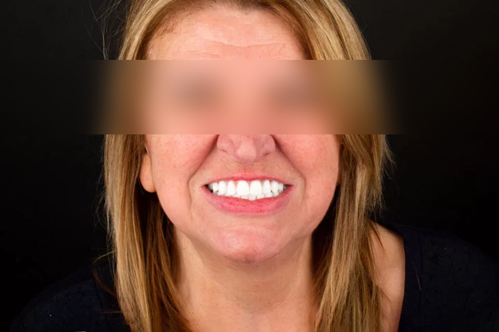 Caso Clínico – Dentes em 1 dia | 2