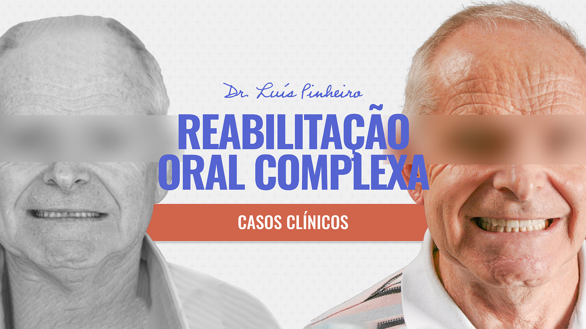 Caso Clínico – Reabilitação Oral Complexa | 1