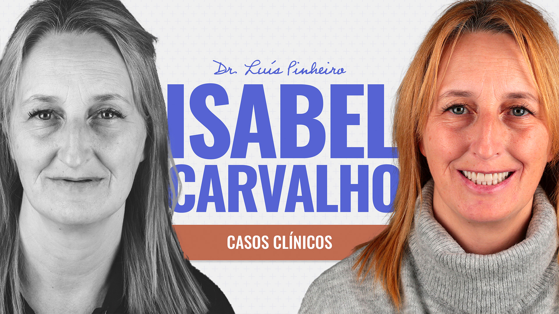 isabel carvalho implantes zigonmáticos