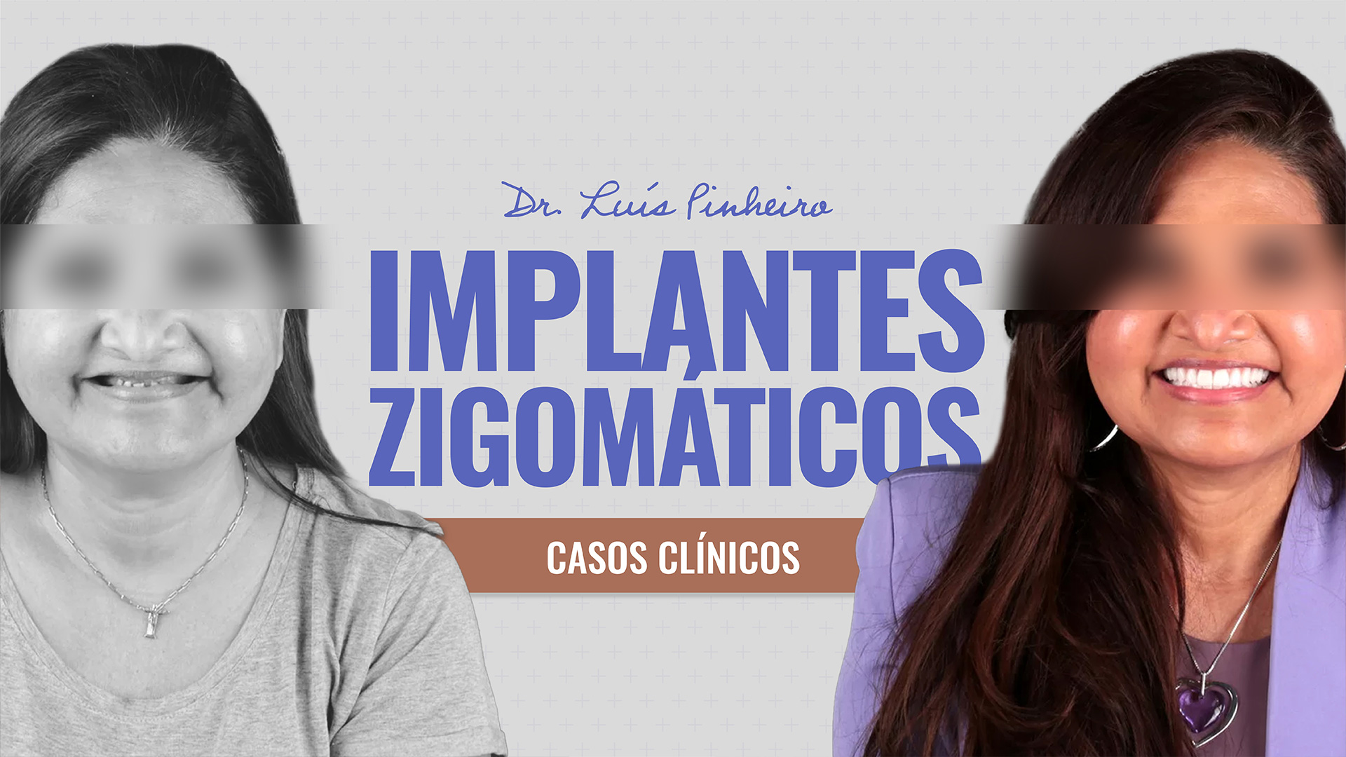 Caso Clínico – Implantes Zigomáticos | 6