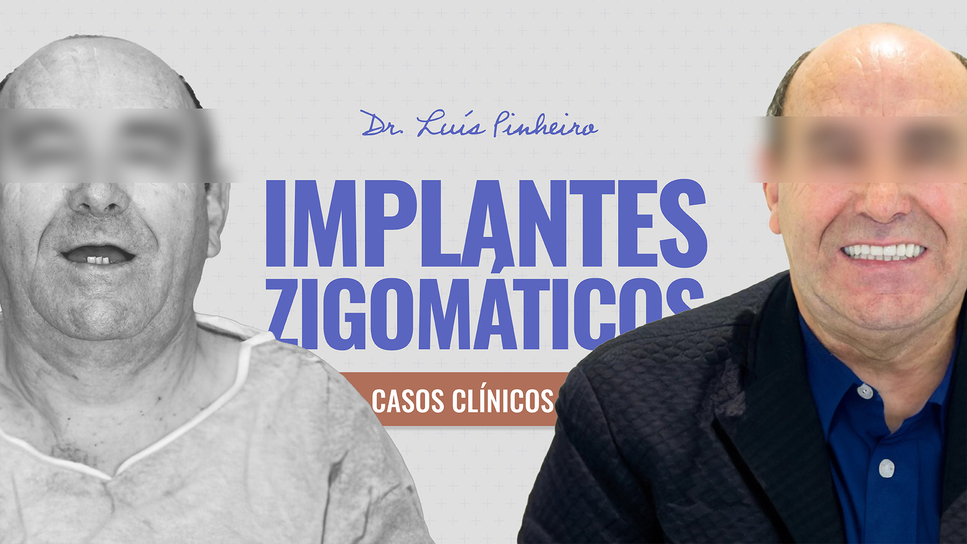 NEW CASE – ZYGOMATIC IMPLANTS