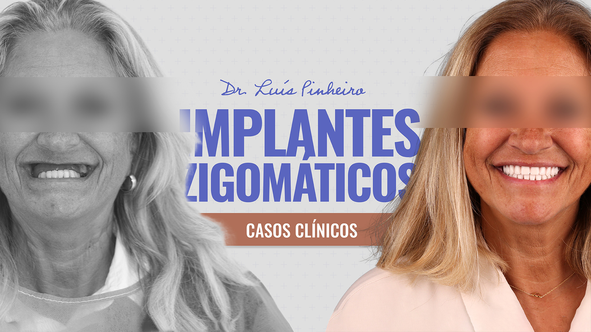 Caso Clínico – Implantes Zigomáticos | 4