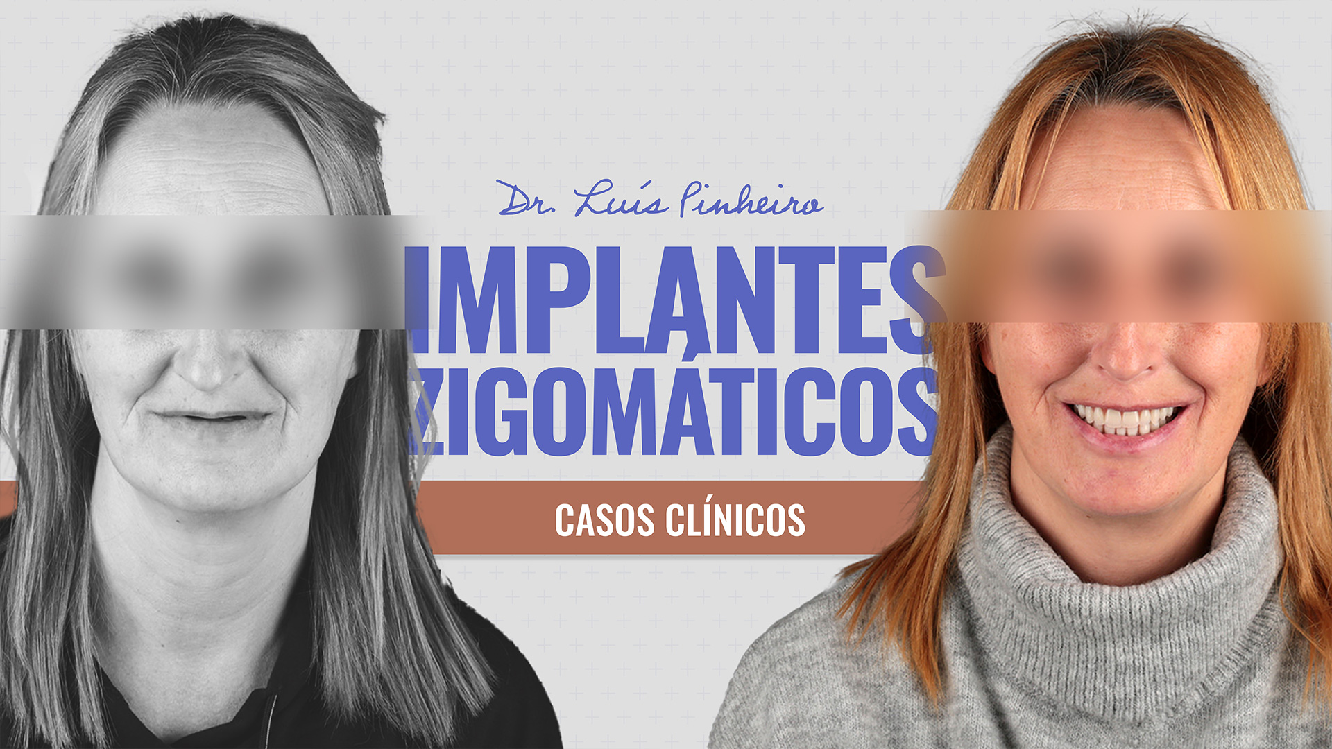 Caso Clínico – Implantes Zigomáticos | 5