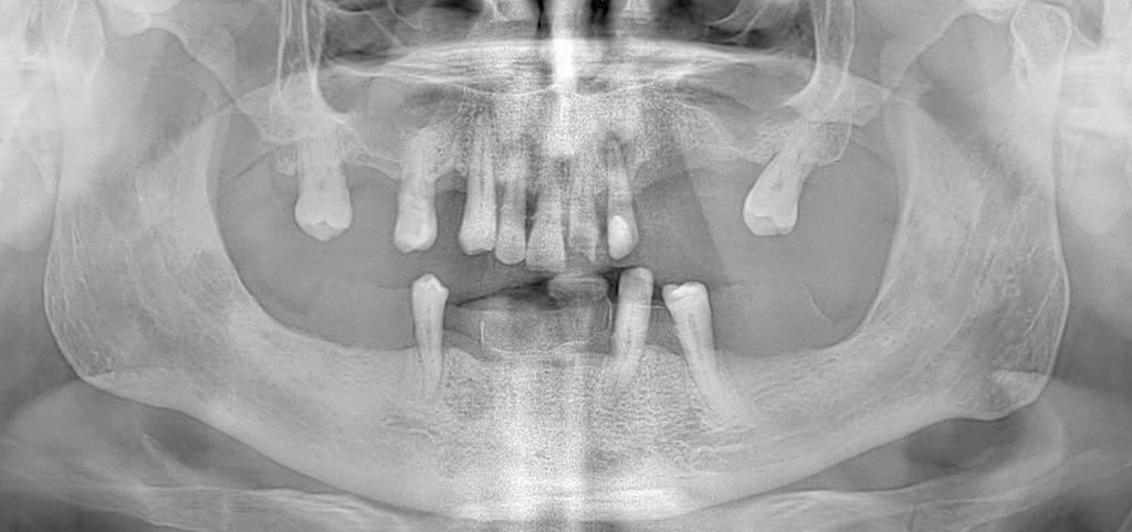 Caso clínico – Dentes em 1 dia 1