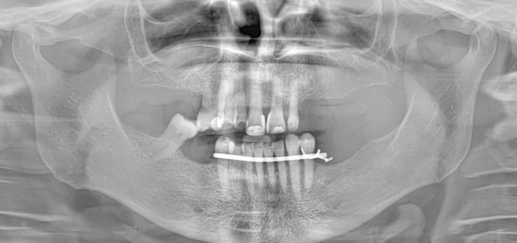 Caso Clínico - Dentes em 1 dia | 18